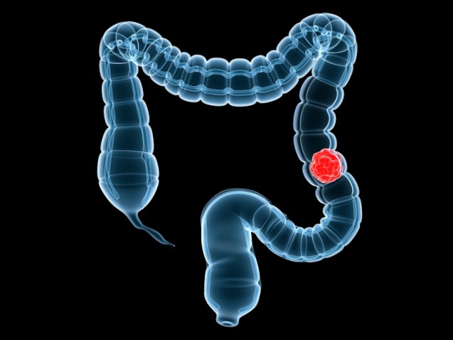 Câncer de intestino grosso: nova descoberta