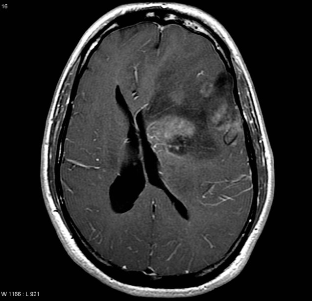 Câncer no cérebro: sintomas, diagnóstico e tratamento
