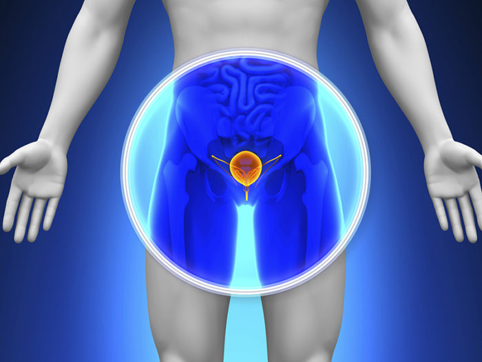 cancer prostata vasectomia)